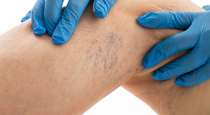 Vascular Treatment Programme in Norwich