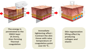 HIFU Treatment Aftercare: What to Do and Avoid