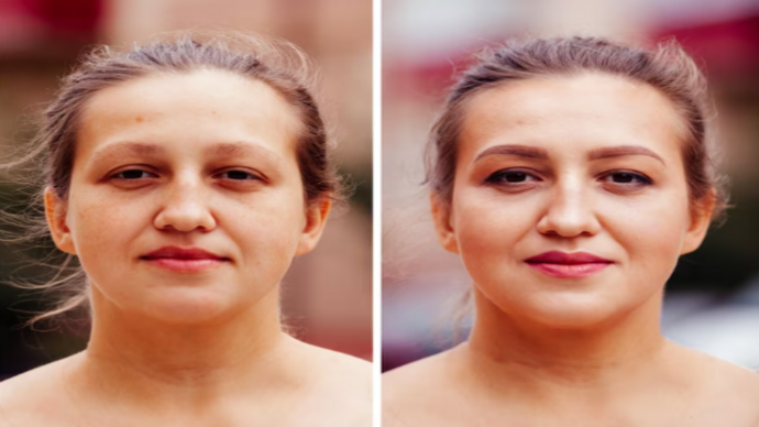 Carbon Laser Facial Treatment: Before and After Guide