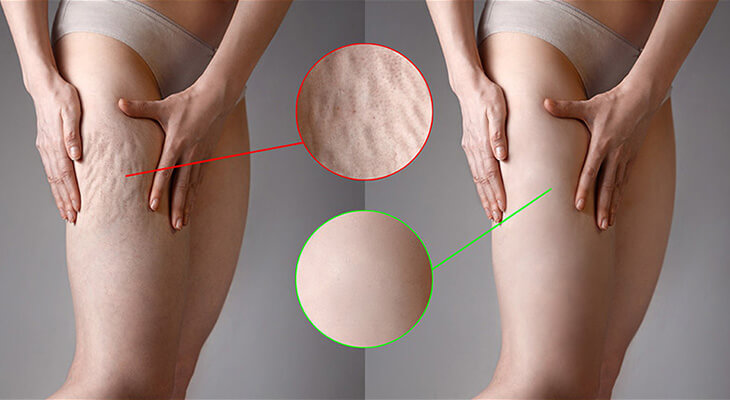 Cellulite Treatment — Collagen Lift Before and After
