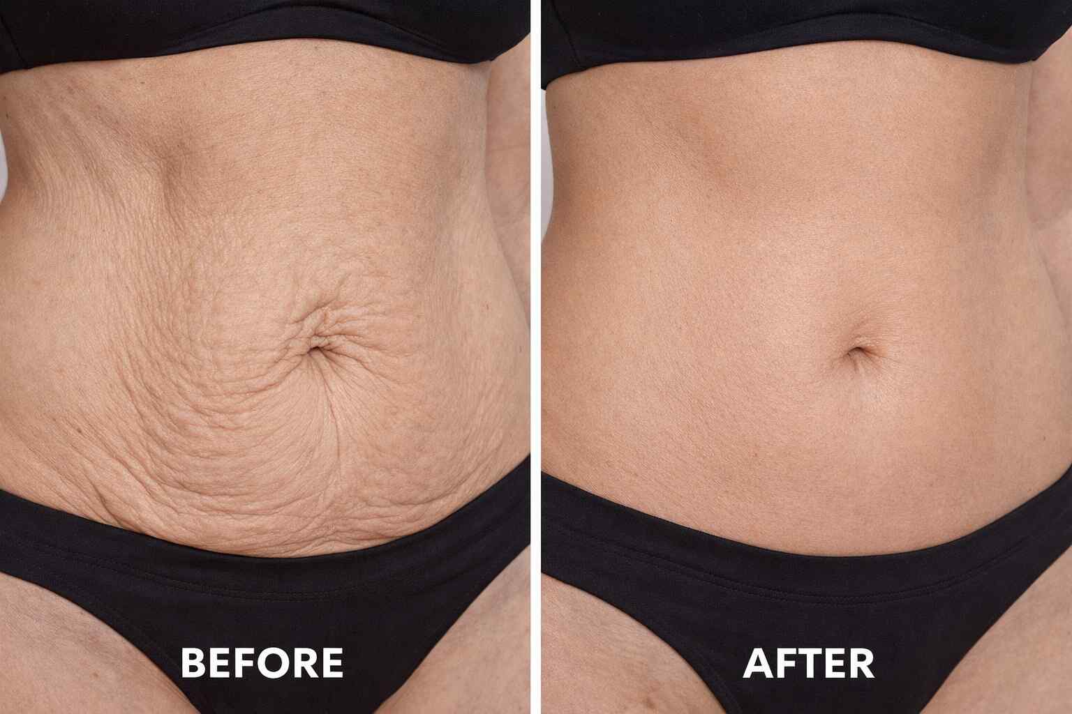 Abdomen Fat Reduction in Norwich