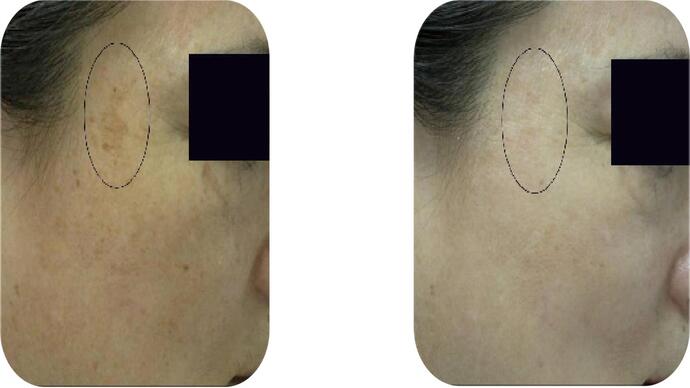 Pigmentation Treatment in Norwich