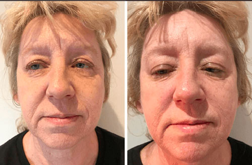 Skin Regeneration Programme