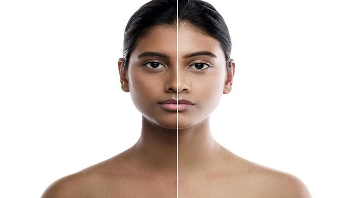Sun Damage Treatment in Norwich