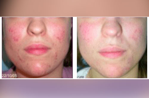 Treatment result