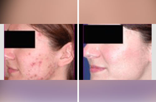 Treatment result