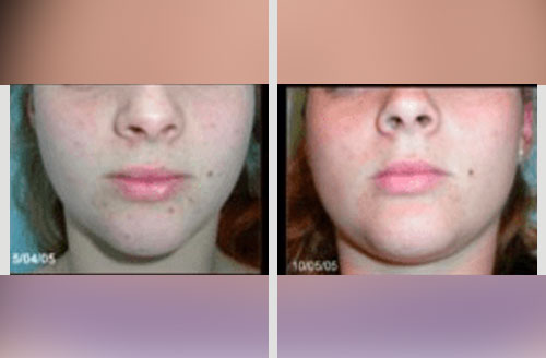 Treatment result