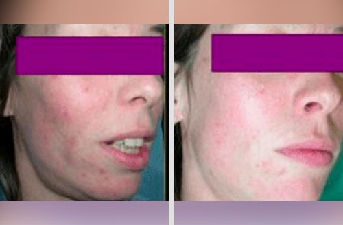 Treatment result