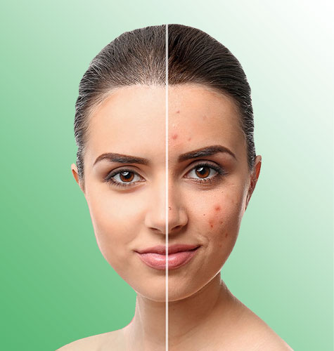 Acne Treatment Programme in Norwich