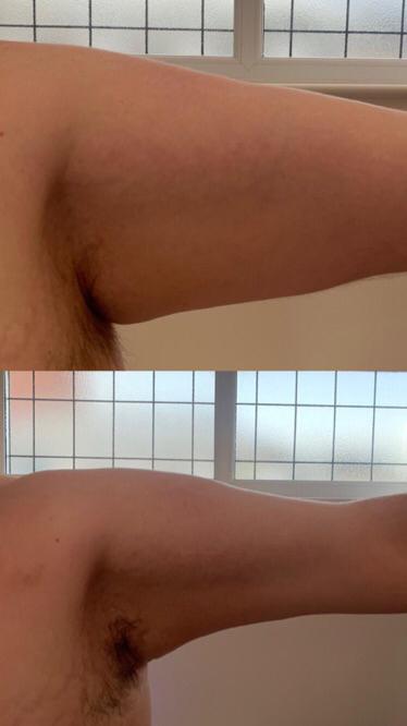 Arm Fat Reduction