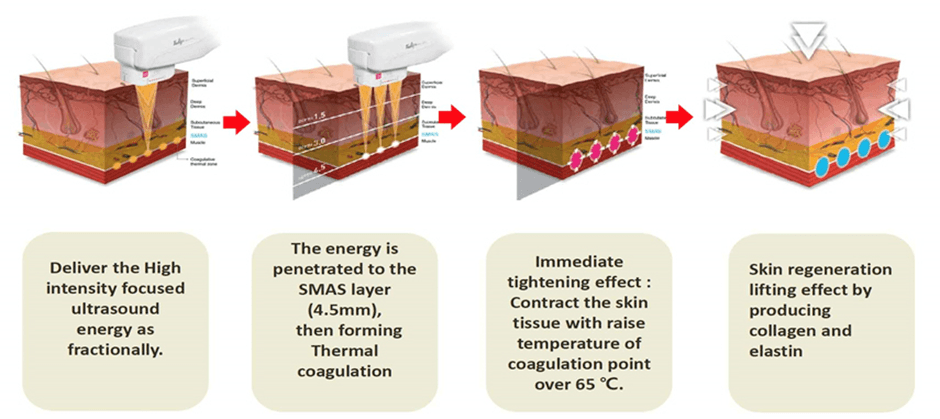 EndoPulse facial treatment — Estetika Clinic Norwich