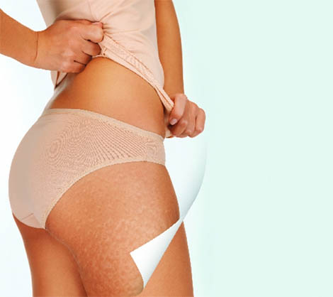 Cellulite Reduction Programme in Norwich