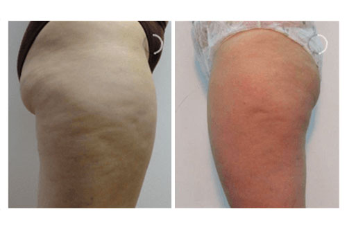 Treatment result