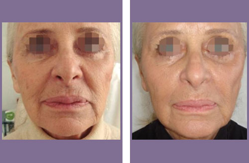 Treatment result