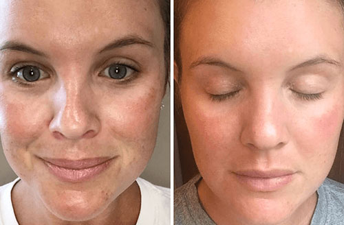 Acne scar treatment result