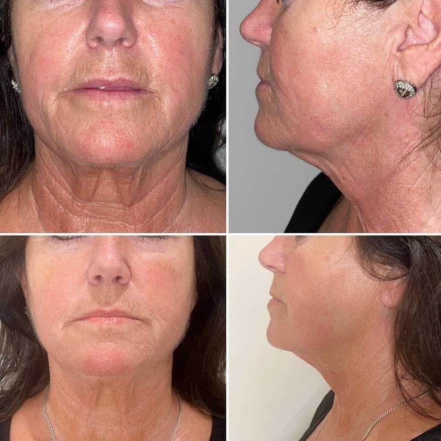 Double Chin — Before & After