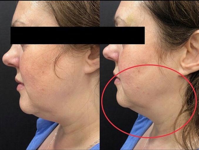 Double Chin Reduction