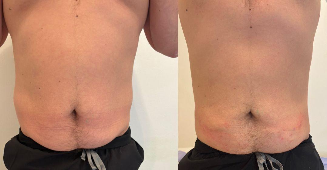 EndoPulse abdomen tightening result Norwich