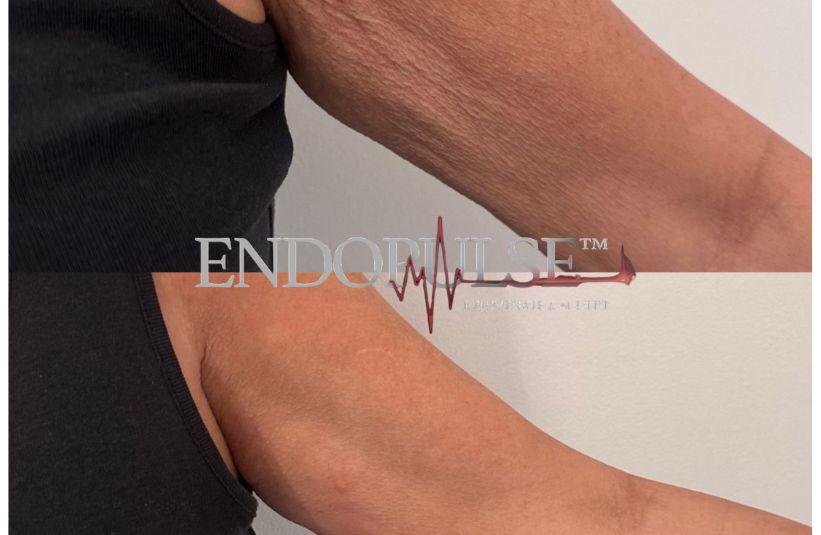 EndoPulse arm tightening result Norwich