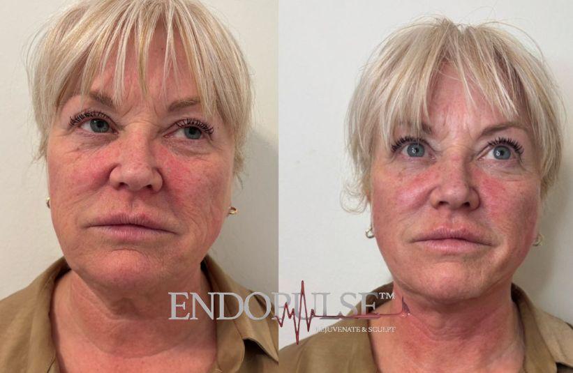 EndoPulse facial rejuvenation result Norwich