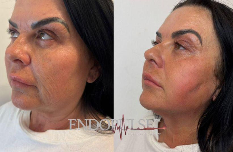 Before and after EndoPulse jawline treatment Norwich