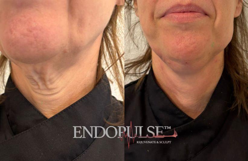 EndoPulse lower face and jowl tightening result Norwich