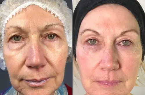 Sensitive skin improvement
