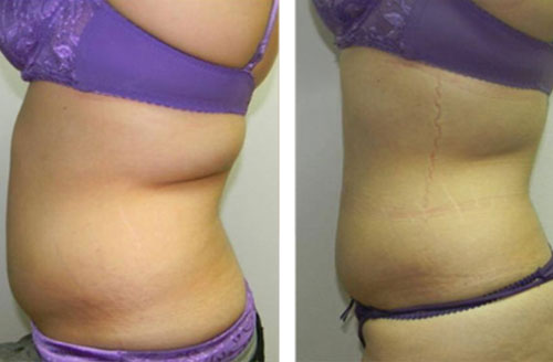 Treatment result