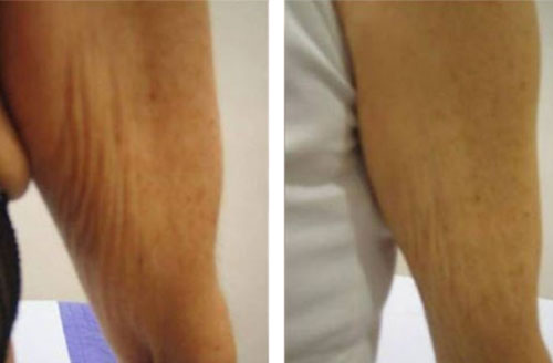 Treatment result