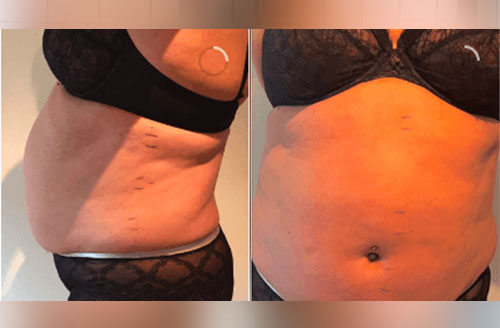 Treatment result