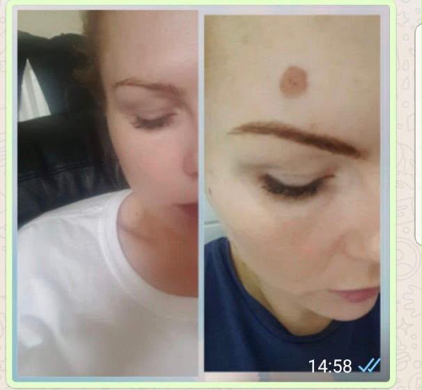 Lesion Removal
