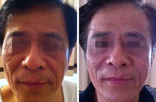 Skin tightening result