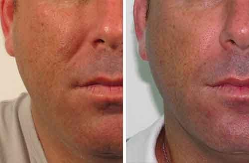 Treatment result