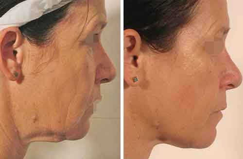 Treatment result