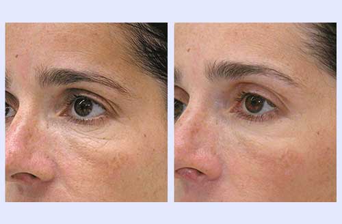 Fine lines improvement 3