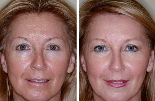 Fine lines improvement 4