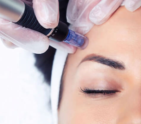 RF Microneedling treatment — Estetika Clinic Norwich