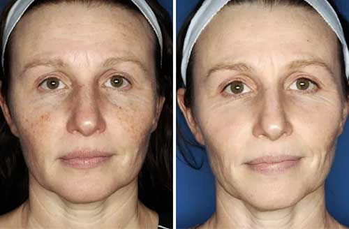Treatment result