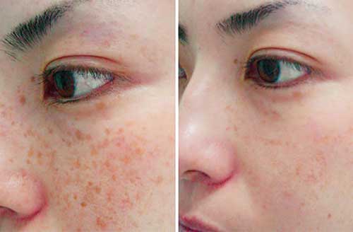 Treatment result