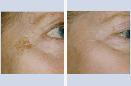 Pigmentation treatment result