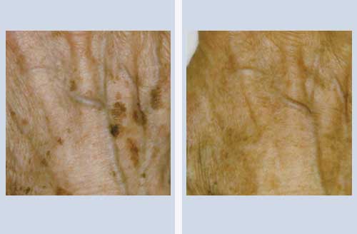 Treatment result