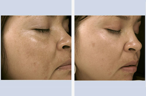 Treatment result