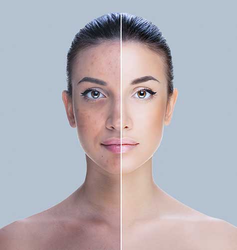 Pigmentation Correction Programme