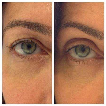 Upper Eyelid (Plasma Fibroblast) — Before & After