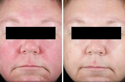Rosacea treatment result