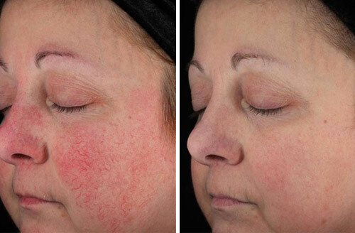 Treatment result