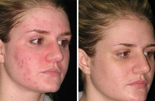 Treatment result