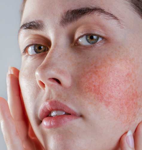 Rosacea Management Programme in Norwich