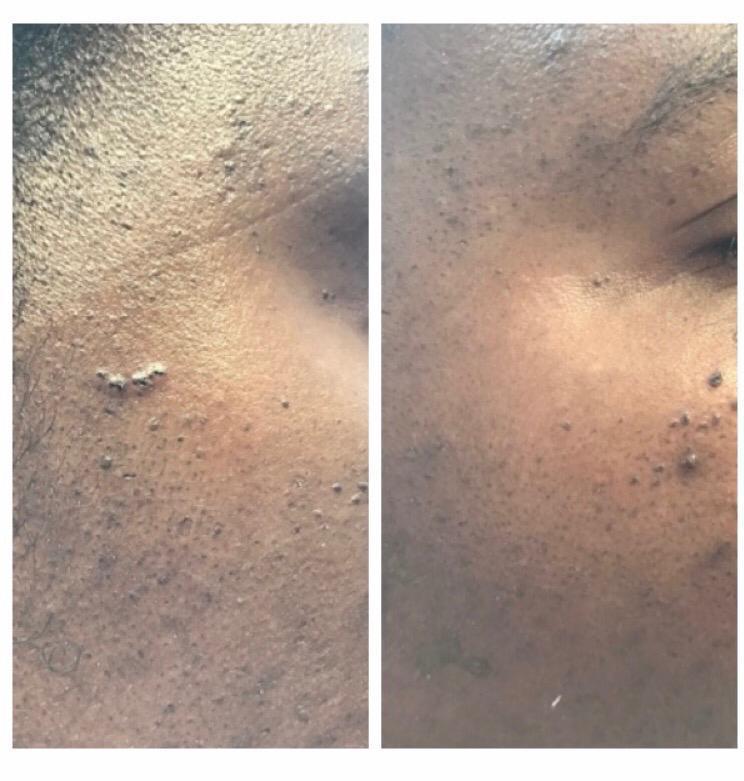 Skin Lesion Removal