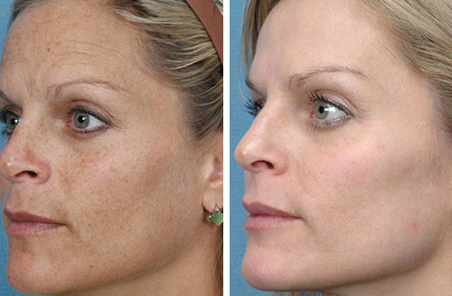 Sun damage skin rejuvenation